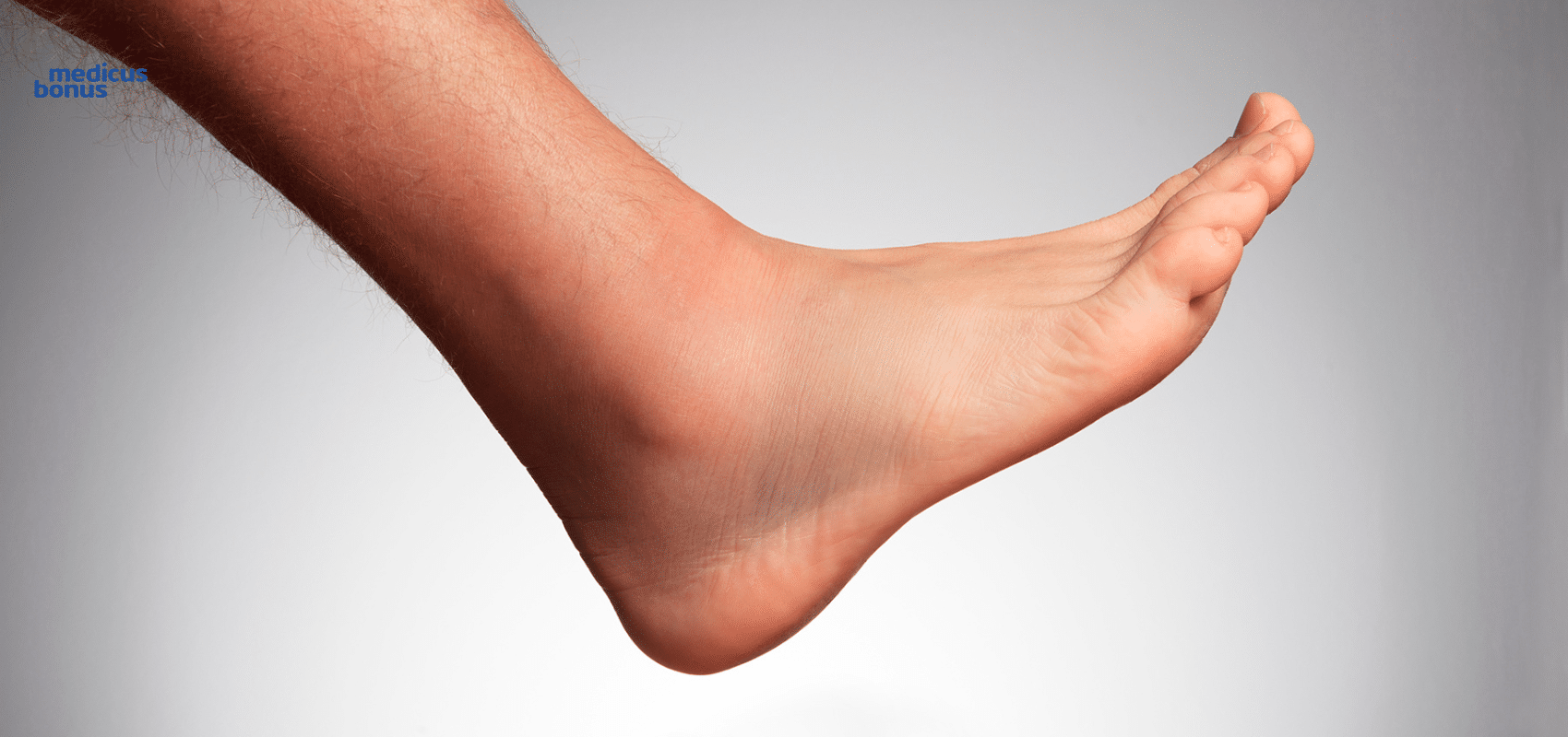 stopa płasko koślawa