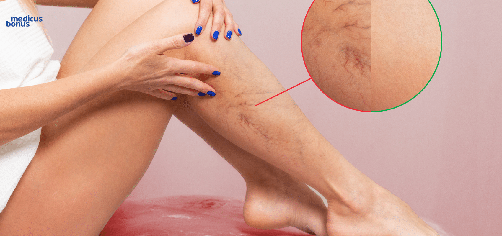 żylaki - nowoczesne metody leczenia